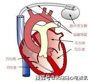 国产心脏起搏器拆解视频,拆解视频带你一探究竟